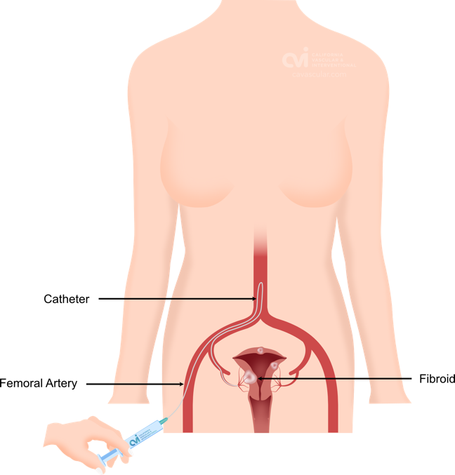 ufe fibroid embolization radial access arm specialist doctor california