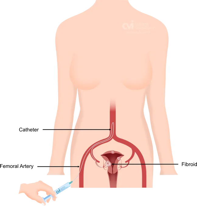 ufe fibroid embolization radial access arm specialist doctor california