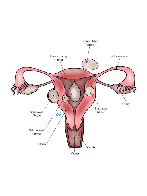 Uterine Adenomyosis