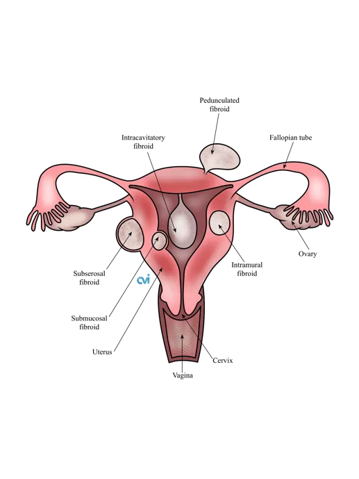 Uterine Adenomyosis