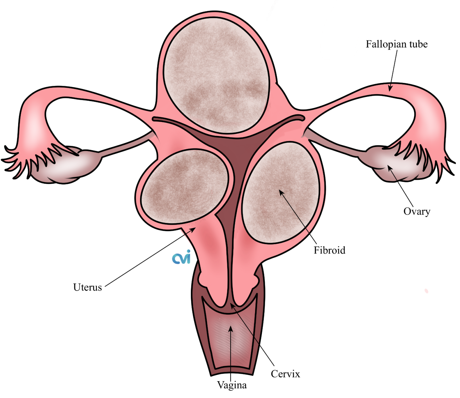 Large Fibroid Uterus Treatment California Specialist Top Doctor