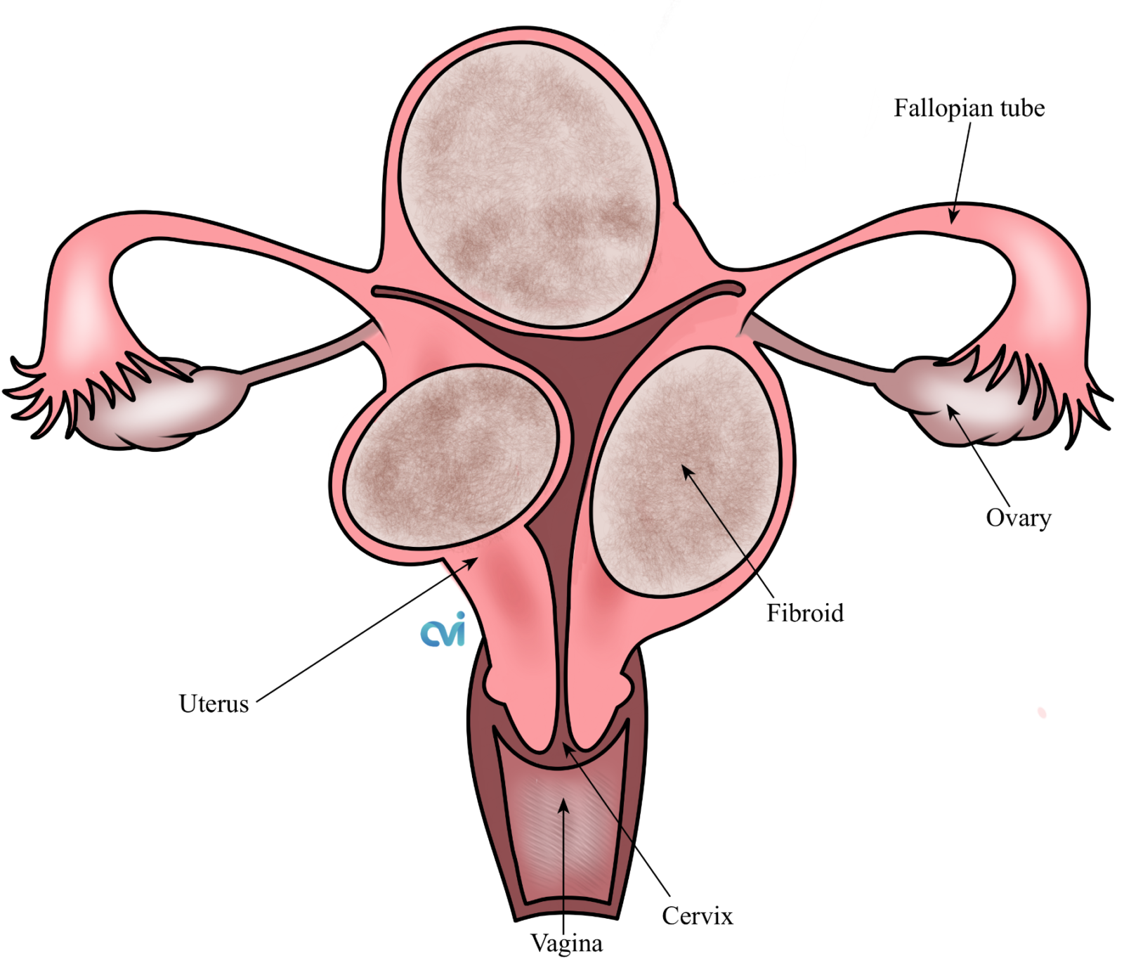 Large Fibroid Uterus Specialist For Effective Treatment   Large Fibroid Uterus E1620010853632 1600x1387 