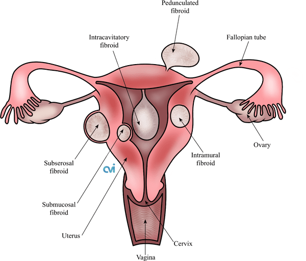 Uterine Fibroids