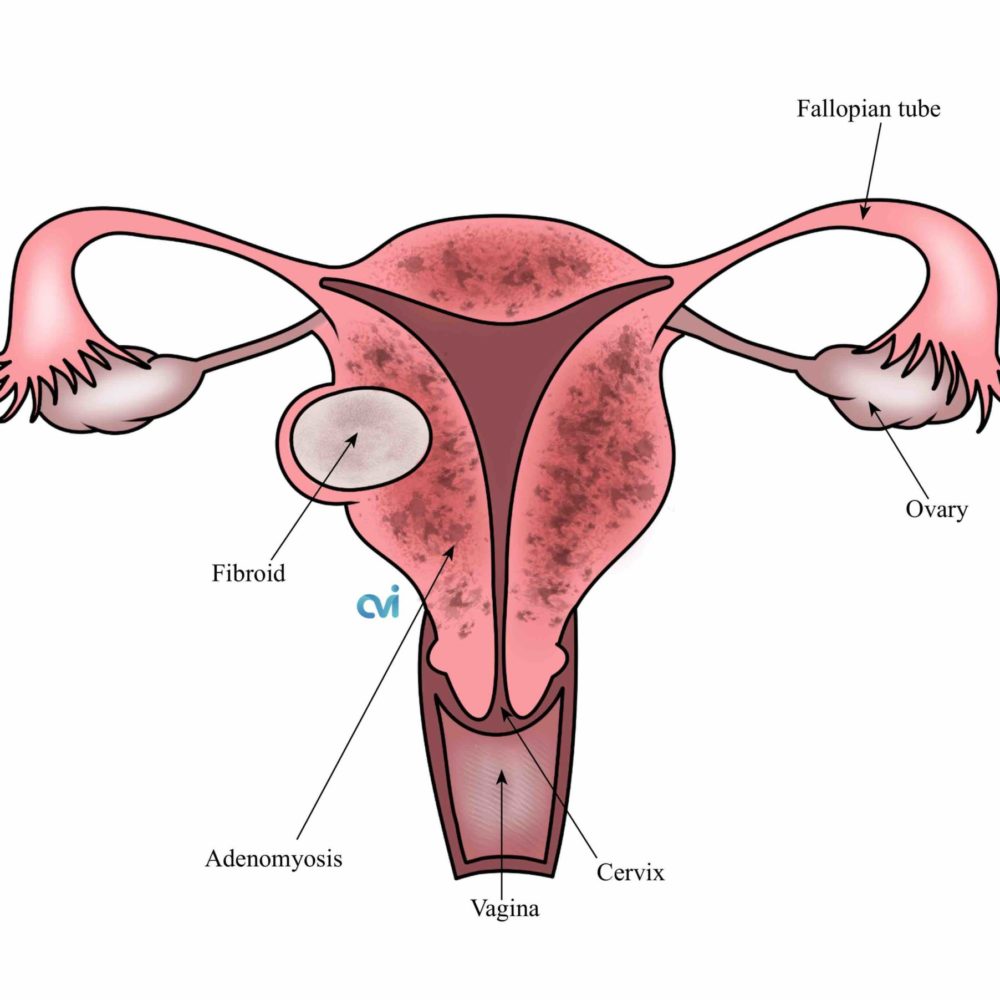 adenomyosis vs endometriosis