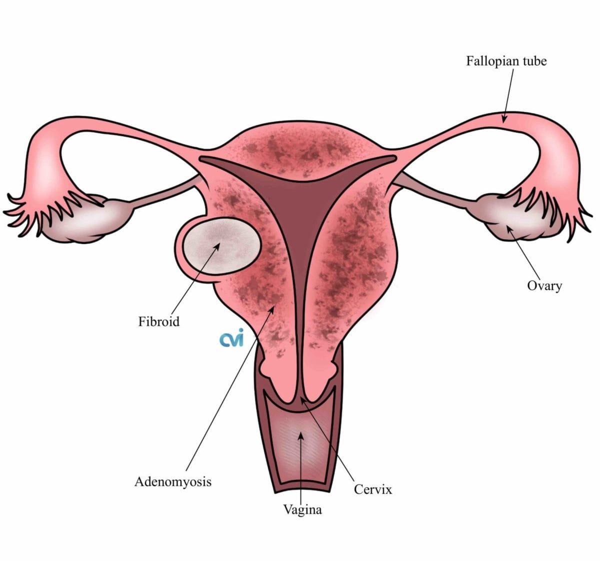 adenomyosis-vs-endometriosis diagram