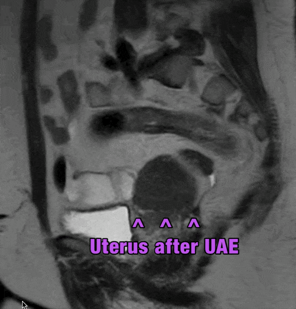Uterus after uae
