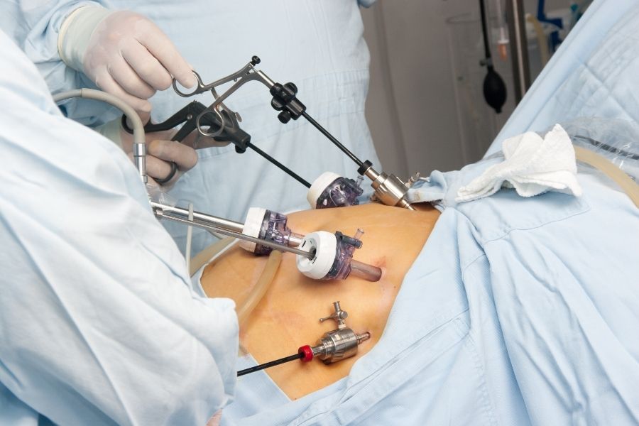 laparoscopic myomectomy scars