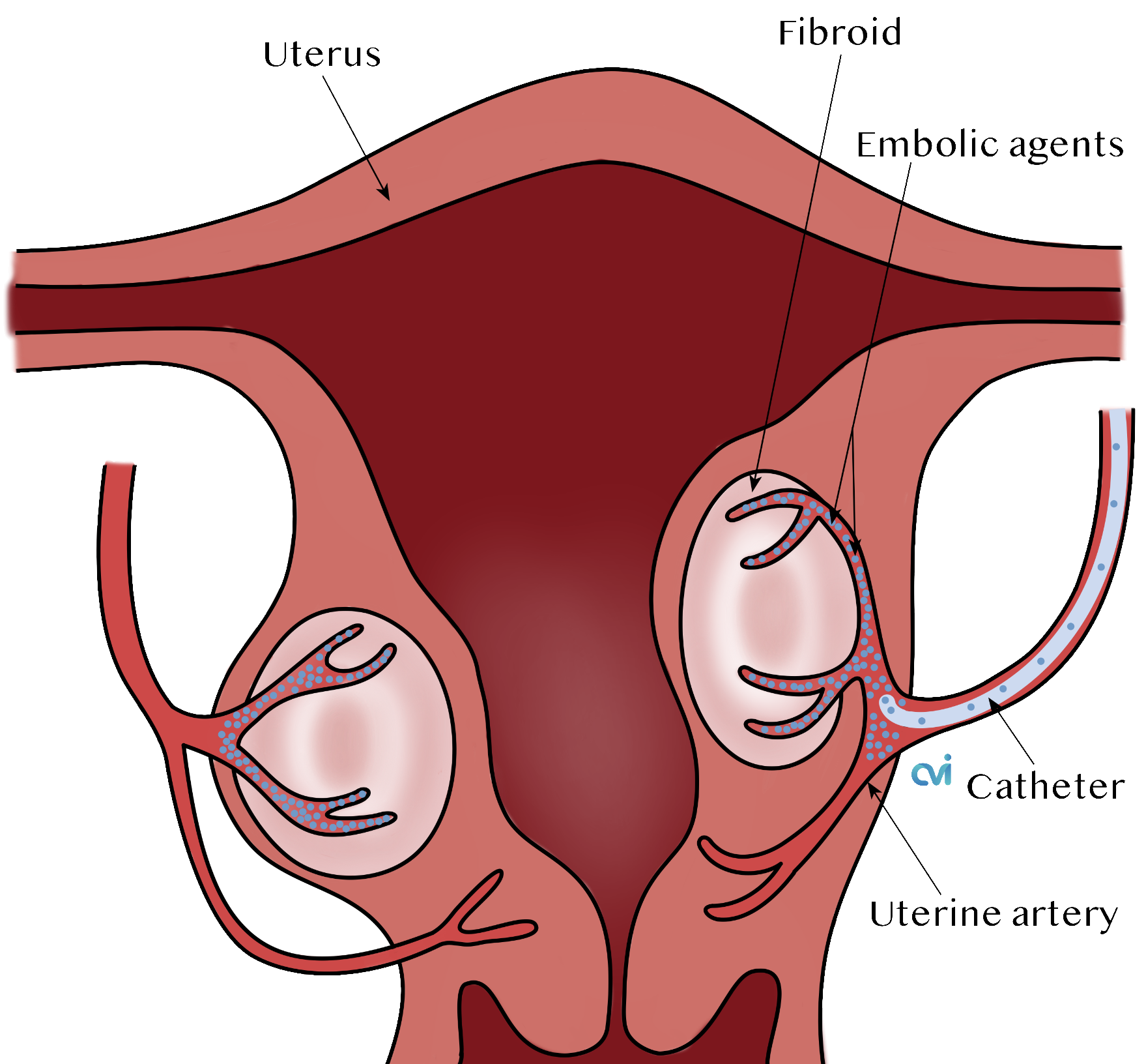 Fibroid Embolization Ufe Treatment Cvi Fibroid Center 