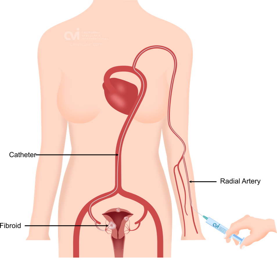 Non-Surgical Embolization California