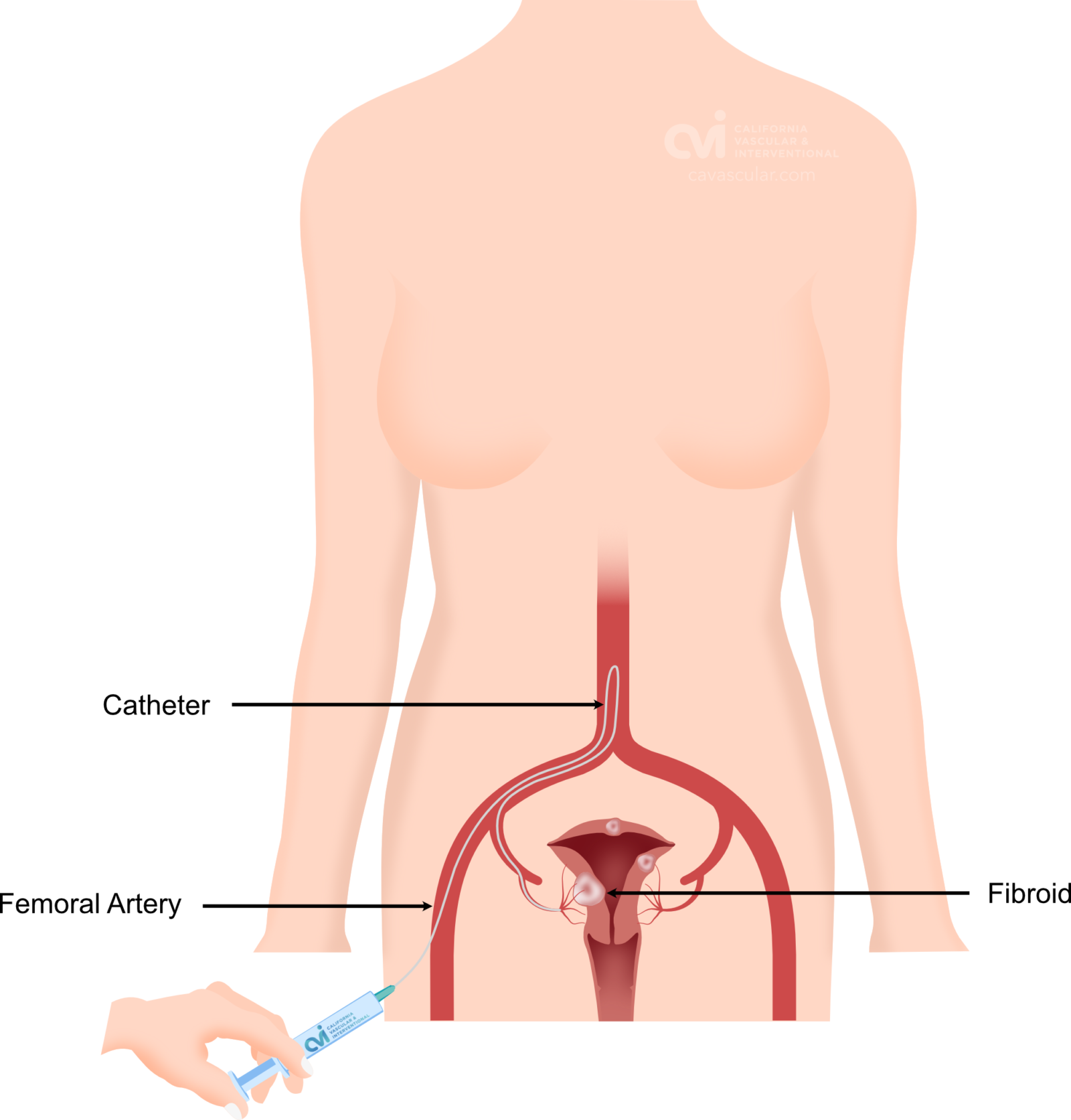 Women illustration of shwoing radial artery