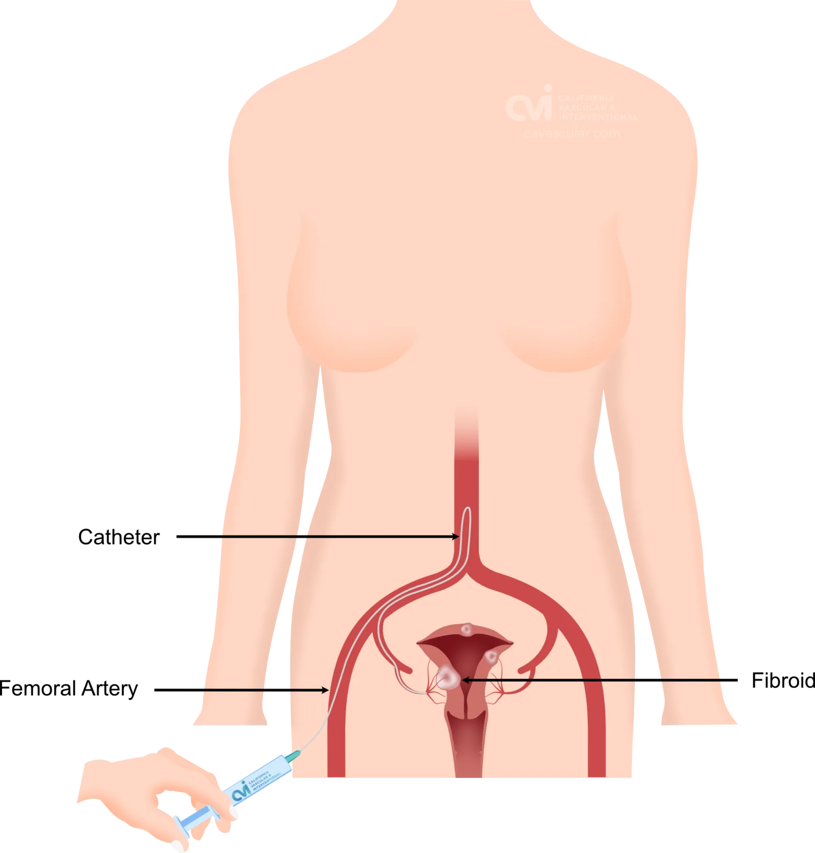 Women illustration of shwoing radial artery