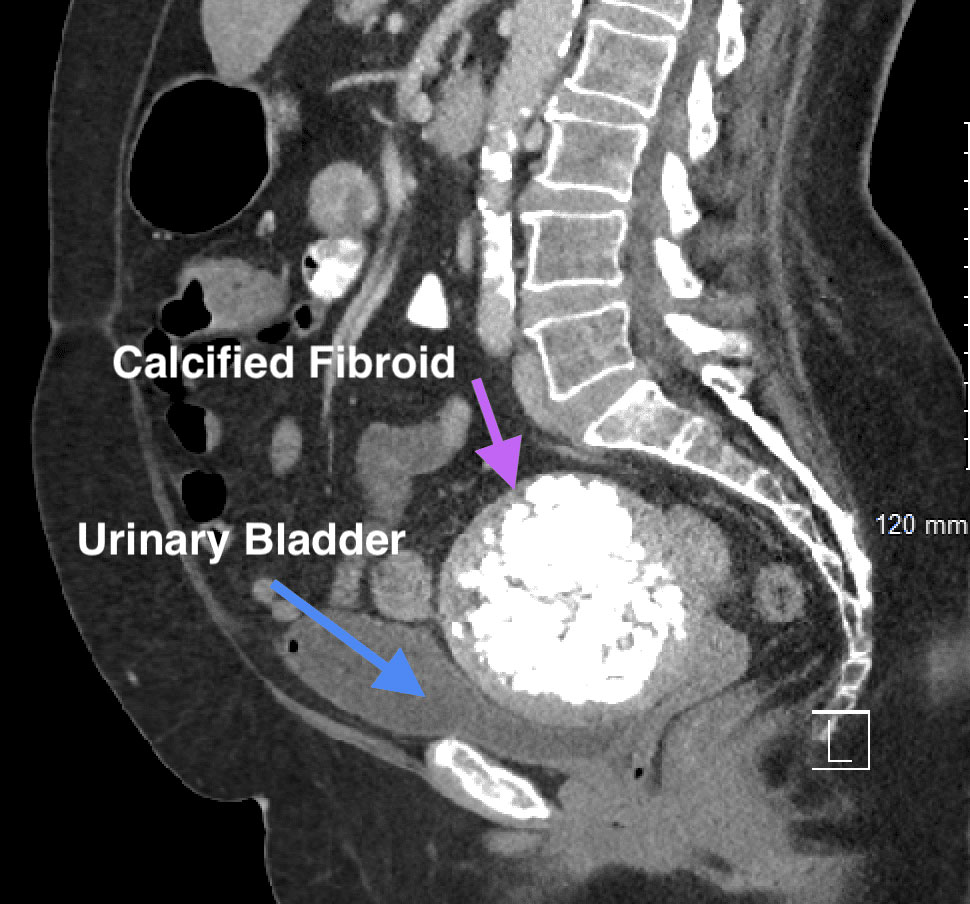 Xray showing calcified fibroid and uniary bladder