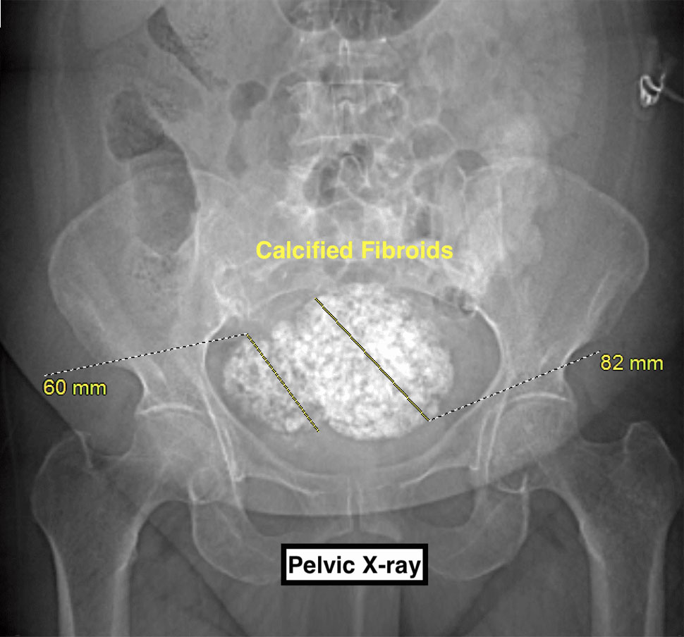 Xray of Calcified fibroids