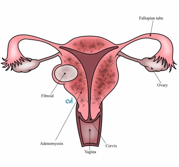 adenomyosis vs endometriosis